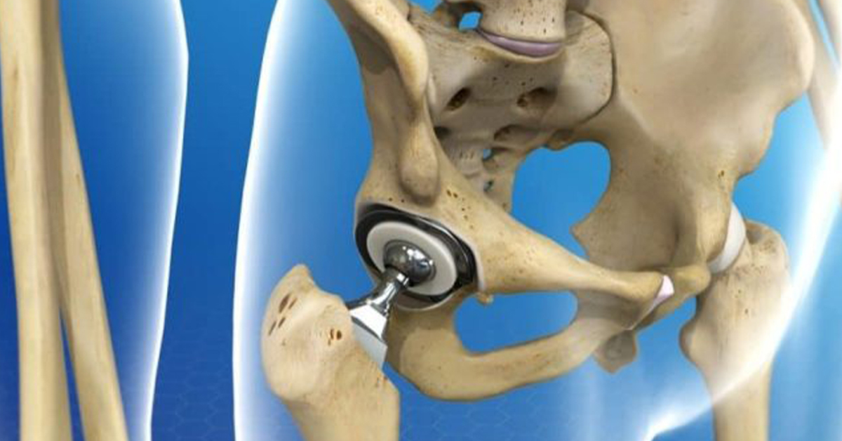 Hip Replacement Facts You May Not Know