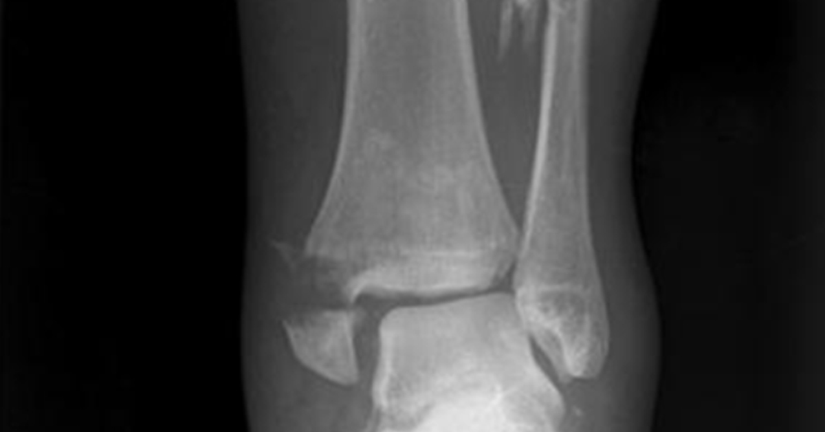 10 Things Palmetto Bone and Joint Wants You to Know About Fractures