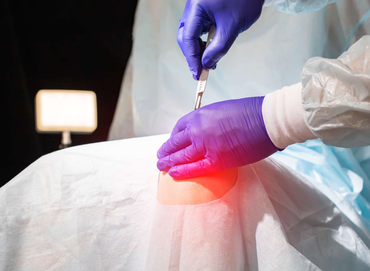 A surgeon wearing purple gloves performing a knee replacement surgery on a patient covered by a white sheet.
