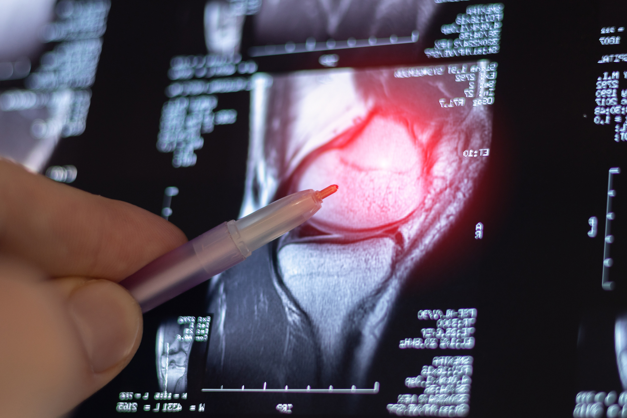An MRI scan of a knee joint illustrating cartilage damage and how cartilage defects are diagnosed in orthopedic medicine.